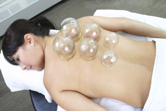 cupping therapy Melbourne