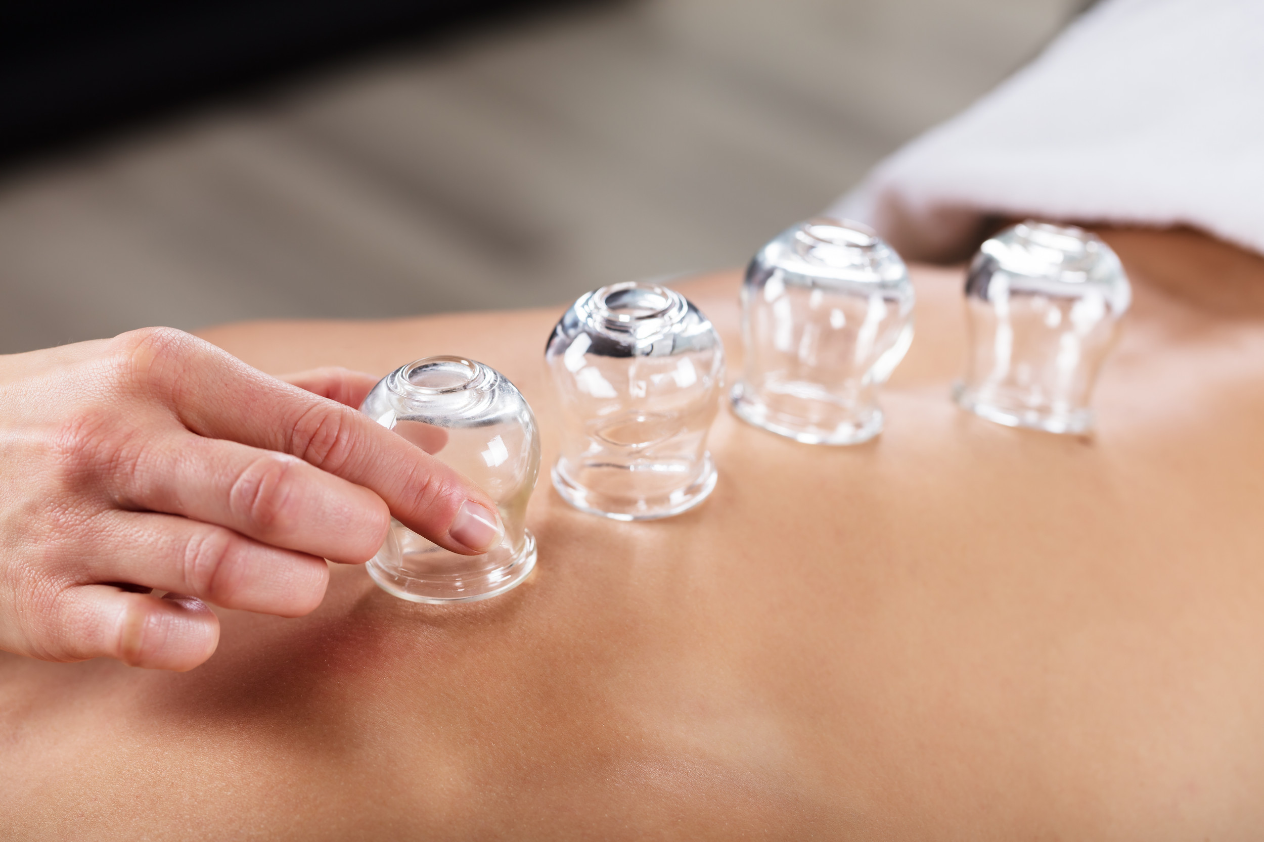 cupping therapy Melbourne