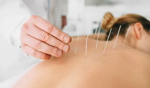 dry needling melbourne