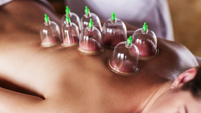 cupping therapy melbourne